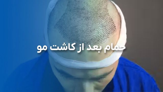 حمام بعد از کاشت مو