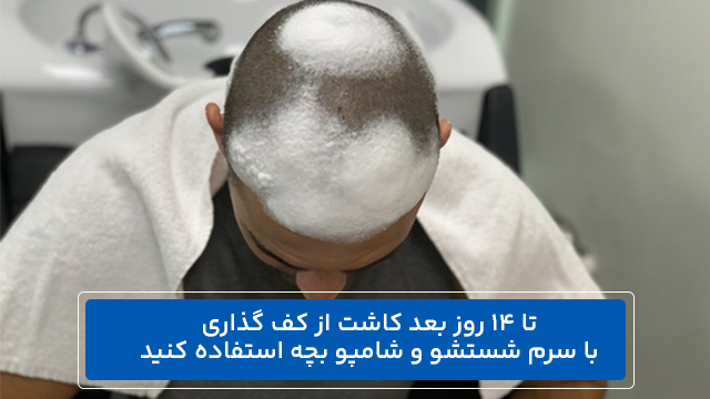 تا 14 روز بعد کاشت از کف گذاری با سرم شستشو و شامپو بچه استفاده کنید.