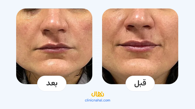 لیزرهای پوستی کلینیک نهال - تصاویر قبل و بعد