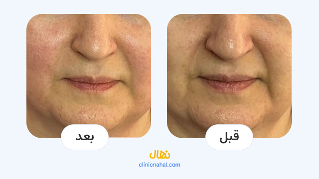 لیزرهای پوستی کلینیک نهال - تصاویر قبل و بعد