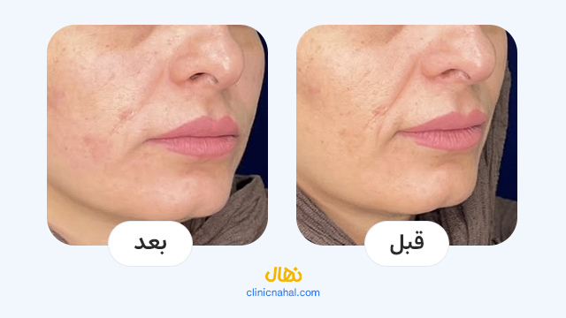 لیزرهای پوستی کلینیک نهال - تصاویر قبل و بعد
