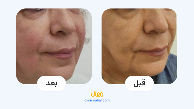 لیزرهای پوستی کلینیک نهال - تصاویر قبل و بعد