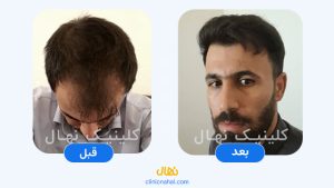 کاشت مو در شیراز - تصویر قبل و بعد کلینیک نهال