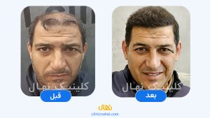 کاشت مو در شیراز - تصویر قبل و بعد کلینیک نهال