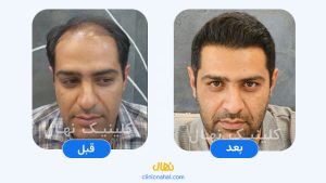 کاشت مو در شیراز - تصویر قبل و بعد کلینیک نهال