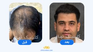 کاشت مو در شیراز - تصویر قبل و بعد کلینیک نهال