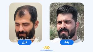 کاشت مو در شیراز - تصویر قبل و بعد کلینیک نهال