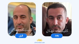 کاشت مو در شیراز - تصویر قبل و بعد کلینیک نهال