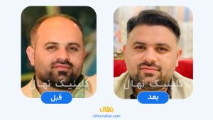 کاشت مو در شیراز - تصویر قبل و بعد کلینیک نهال