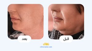تصاویر قبل و بعد اندولیفت در شیراز - کلینیک نهال