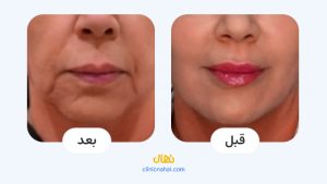 تصاویر قبل و بعد اندولیفت در شیراز - کلینیک نهال