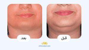 تصاویر قبل و بعد اندولیفت در شیراز - کلینیک نهال