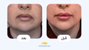 تصاویر قبل و بعد اندولیفت در شیراز - کلینیک نهال