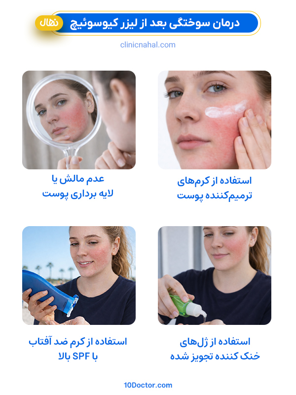 درمان سوختگي بعد از ليزر کیوسوئیچ