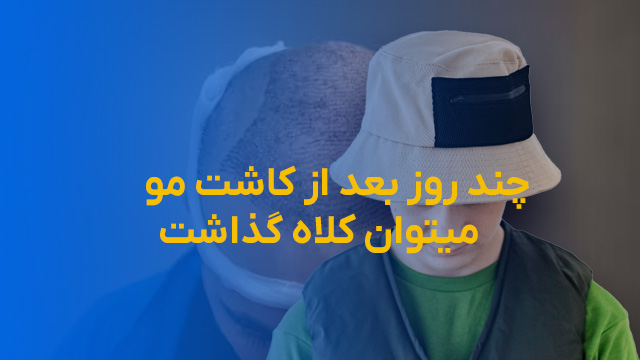 چند روز بعد از کاشت مو میتوان کلاه گذاشت؟