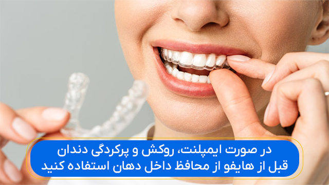 در صورت ایمپلنت، روکش و پرکردگی دندان، قبل از هایفو از محافظ داخل دهان استفاده کنید.