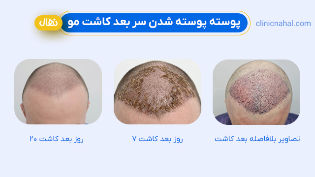 پوسته پوسته شدن سر بعد کاشت مو