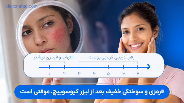 قرمزی و سوختگی خفیف بعد از لیزر کیوسوییچ، موقتی است.