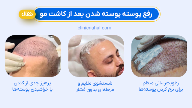 رفع پوسته پوسته شدن بعد از کاشت مو