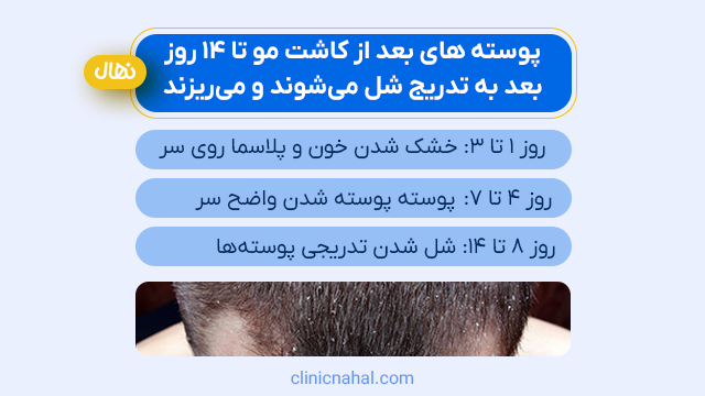 پوسته های بعد از کاشت مو تا 14 روز بعد به تدریج شل میشوند و میریزند.