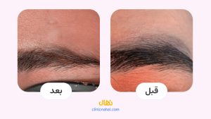 لیزر کیوسوئیچ در شیراز - کلینیک نهال تصاویر قبل و بعد