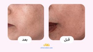 لیزر کیوسوئیچ در شیراز - کلینیک نهال تصاویر قبل و بعد