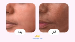 لیزر کیوسوئیچ در شیراز - کلینیک نهال تصاویر قبل و بعد