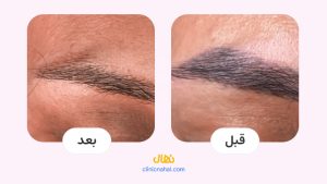 لیزر کیوسوئیچ در شیراز - کلینیک نهال تصاویر قبل و بعد