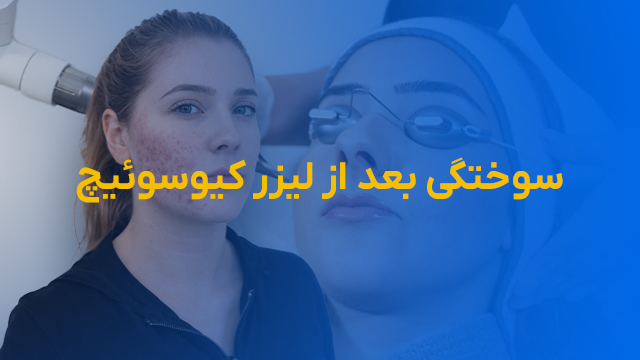 قرمزی و سوختگی بعد از لیزر کیوسوئیچ