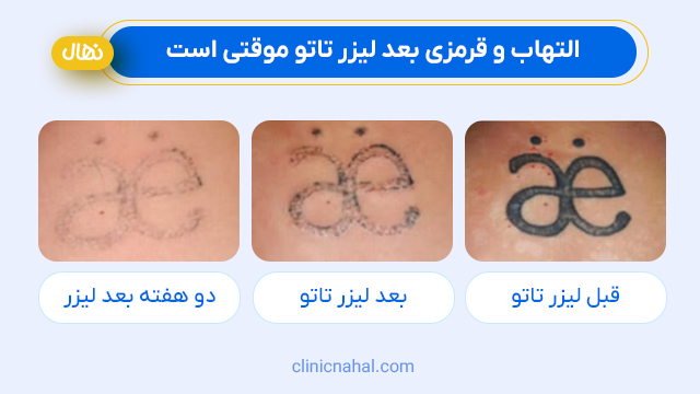 التهاب و قرمزی بعد لیزر تاتو موقتی است.