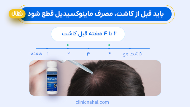باید قبل از کاشت، مصرف ماینوکسیدیل قطع شود.