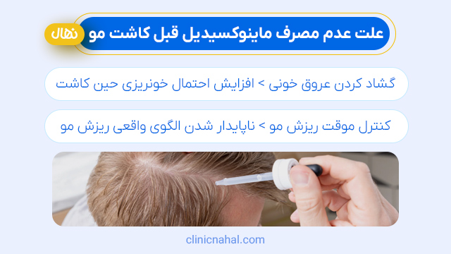 علت عدم مصرف ماینوکسیدیل قبل کاشت مو