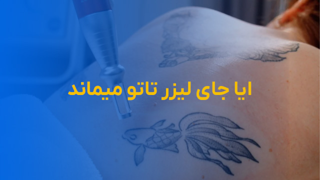 ایا جای لیزر تاتو میماند؟