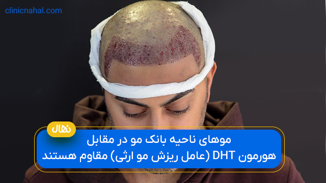 موهای ناحیه بانک مو در مقابل هورمون DHT (عامل ریزش مو ارثی) مقاوم هستند.