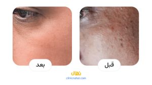 قبل و بعد لیزر فوتونا در شیراز - کلینیک نهال