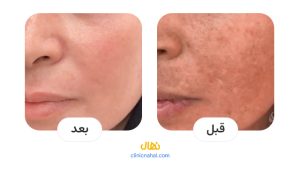 قبل و بعد لیزر فوتونا در شیراز - کلینیک نهال