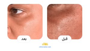 قبل و بعد لیزر فوتونا در شیراز - کلینیک نهال