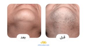 لیزر کندلا در شیراز - کلینیک نهال