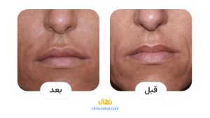 تصاویر قبل و بعد لیزر ویرچو در شیراز - کلینیک نهال