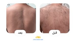 لیزر کندلا در شیراز - کلینیک نهال