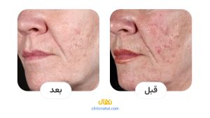 تصاویر قبل و بعد لیزر ویرچو در شیراز - کلینیک نهال