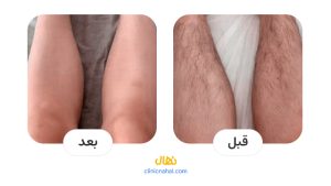 لیزر کندلا در شیراز - کلینیک نهال